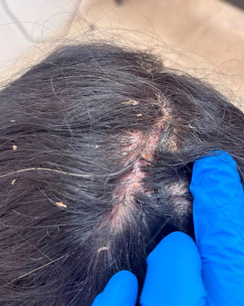 Cuero cabelludo con lesiones activas de foliculitis decalvans